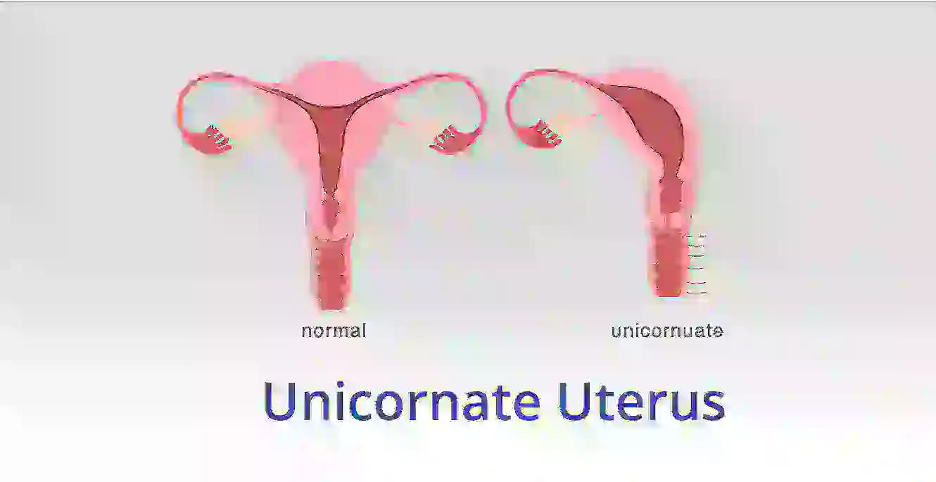 युनिकॉर्न्युएट गर्भाशय: याचा प्रजनन आणि गर्भधारणेवर कसा परिणाम होतो