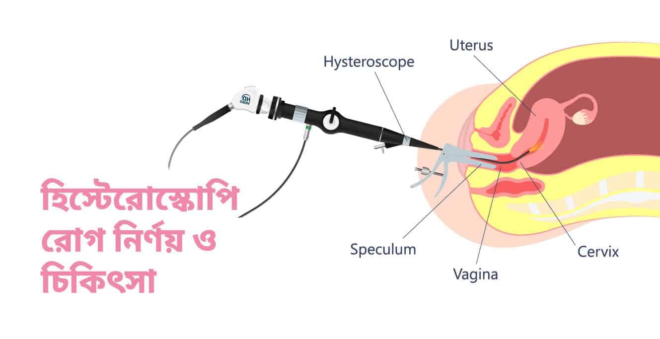 জরায়ুর সমস্যা দূর হিস্টেরোস্কোপি-তে