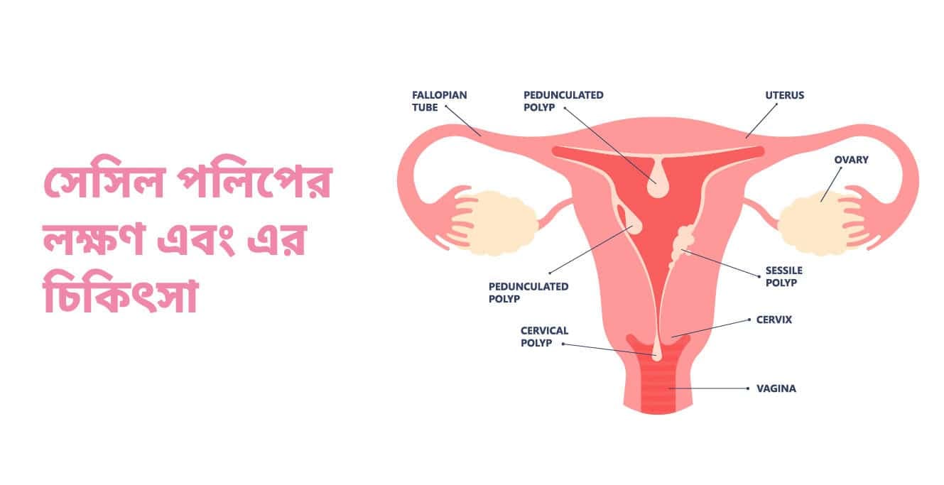 সেসাইল পলিপস – লক্ষণ, কারণ, চিকিৎসা