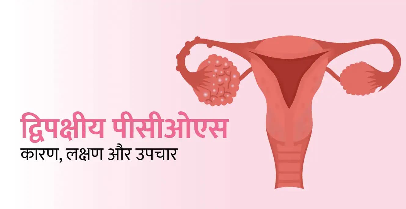 बायलैटरल पीसीओएस: कारण, लक्षण और उपचार
