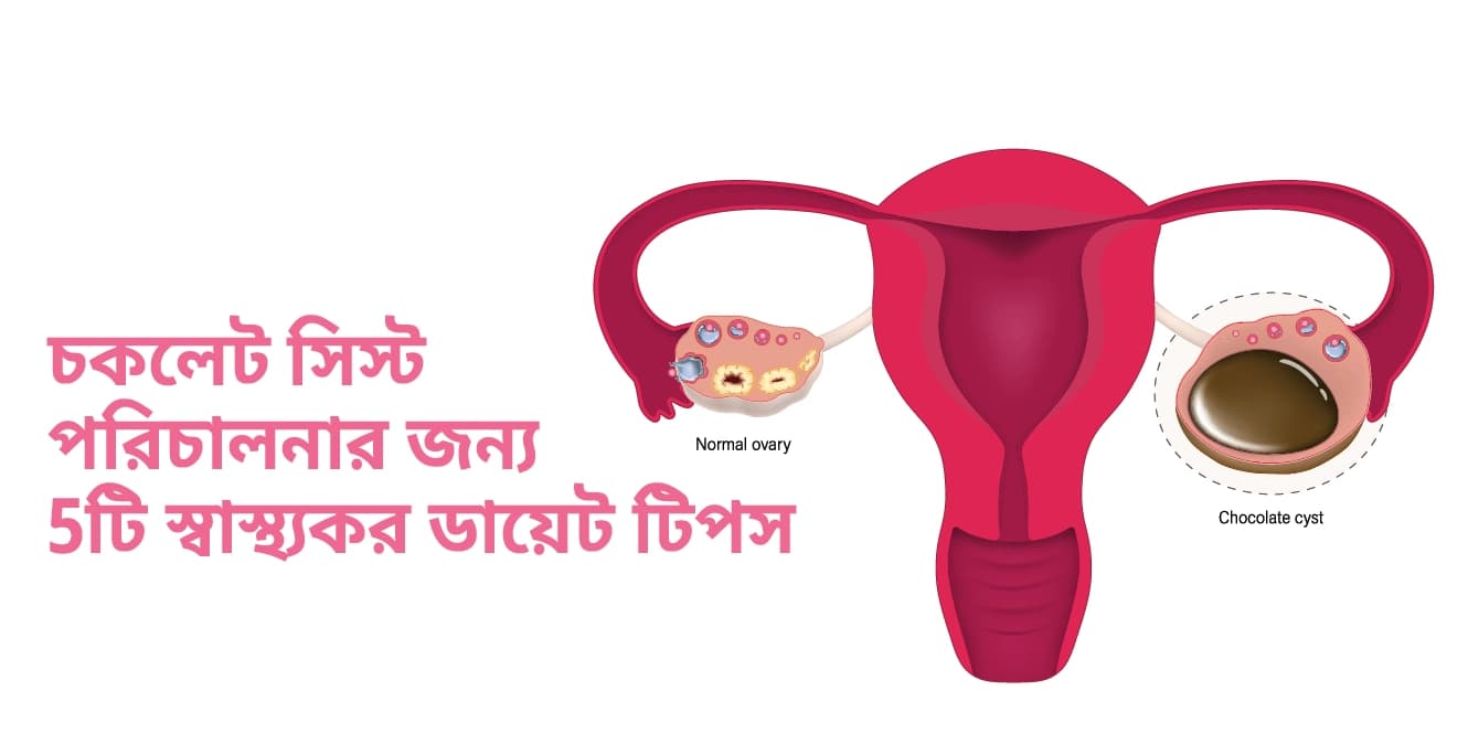 চকলেট সিস্ট পরিচালনার জন্য 5টি স্বাস্থ্যকর ডায়েট টিপস