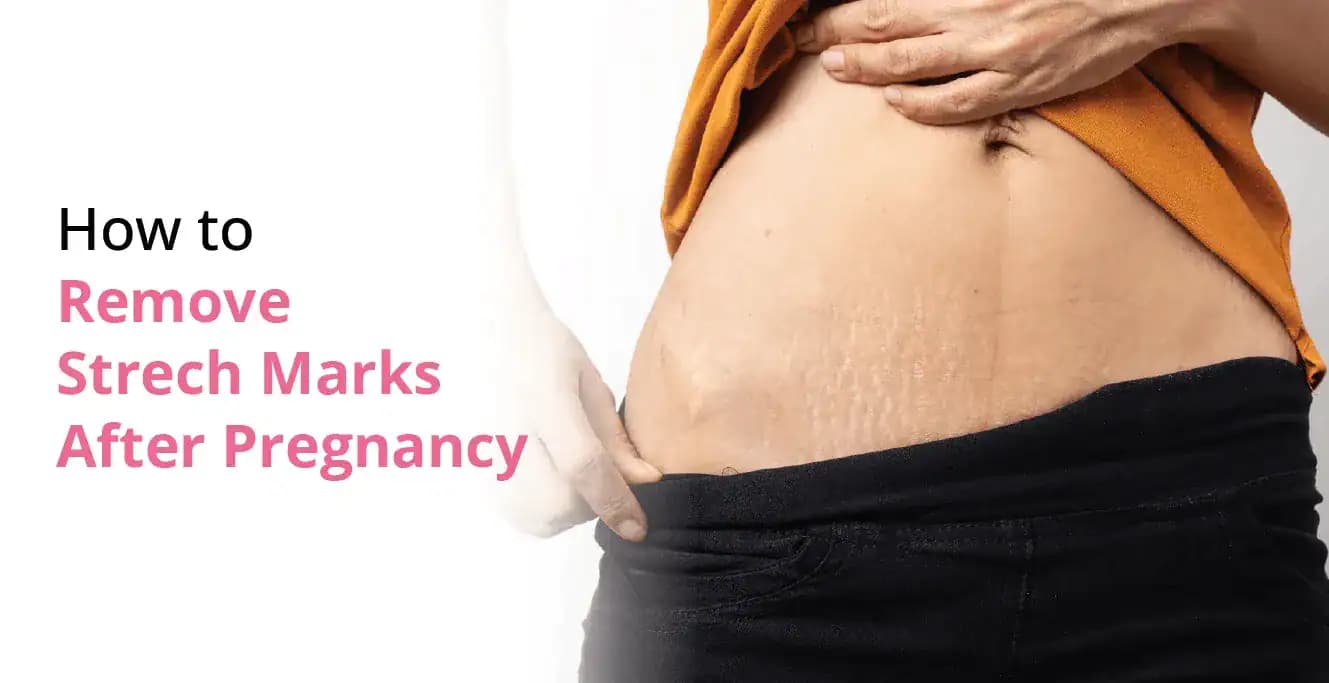 How to Remove Stretch Marks After Pregnancy
