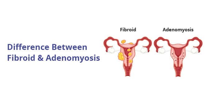 Understanding the Difference Between Fibroids and Adenomyosis