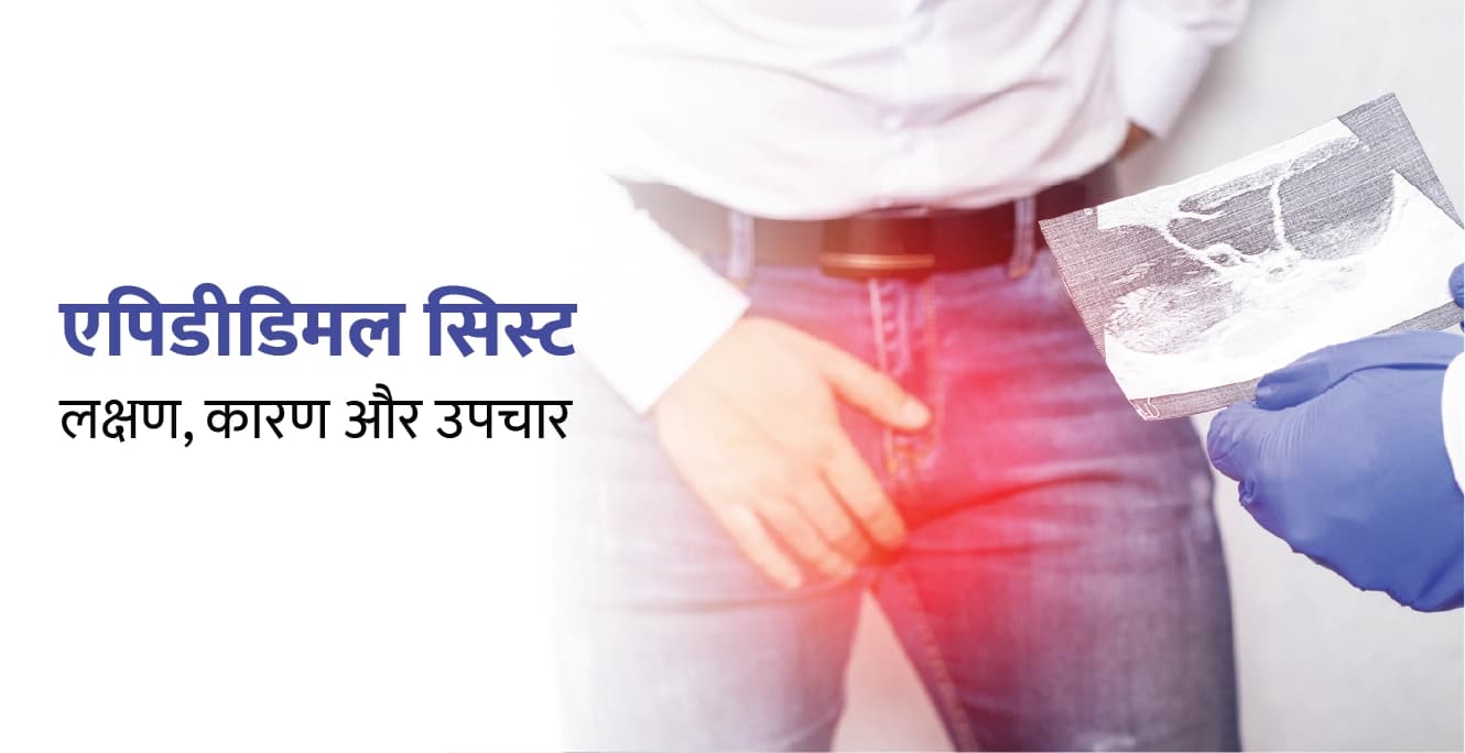 एपिडीडिमल सिस्ट: कारण, लक्षण और उपचार