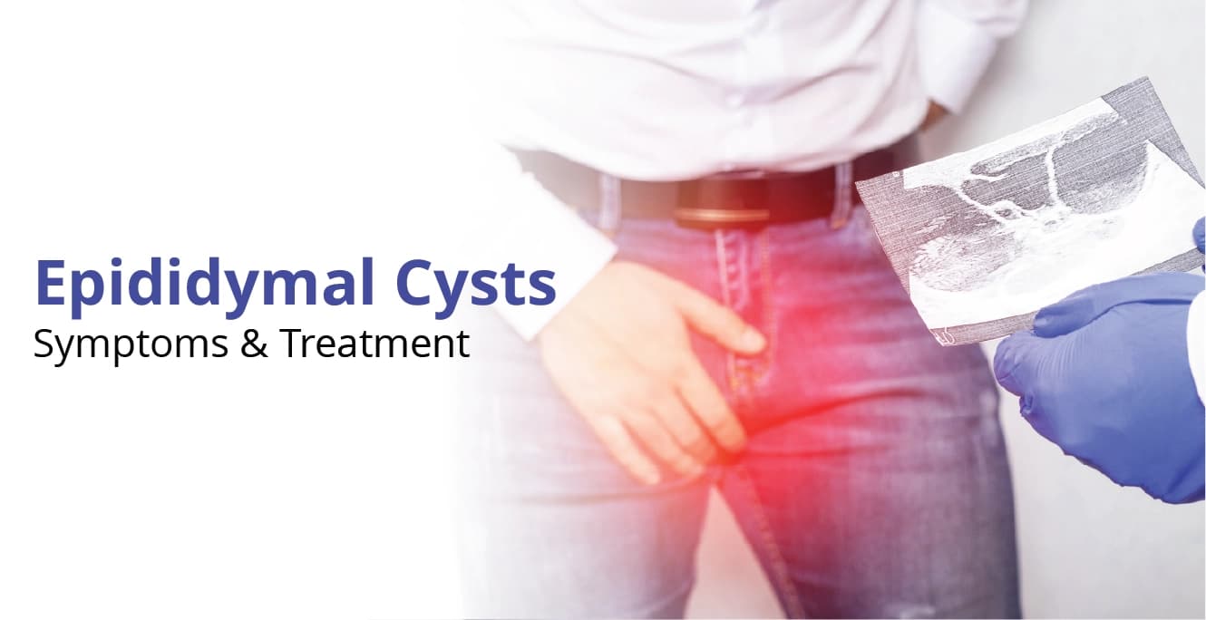 Epididymal Cysts: Symptoms & Treatment