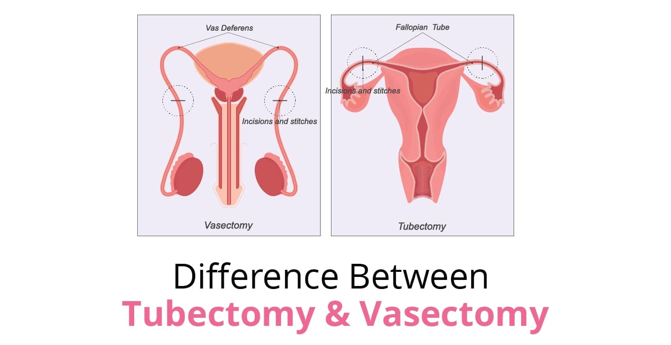 Difference Between Tubectomy and Vasectomy