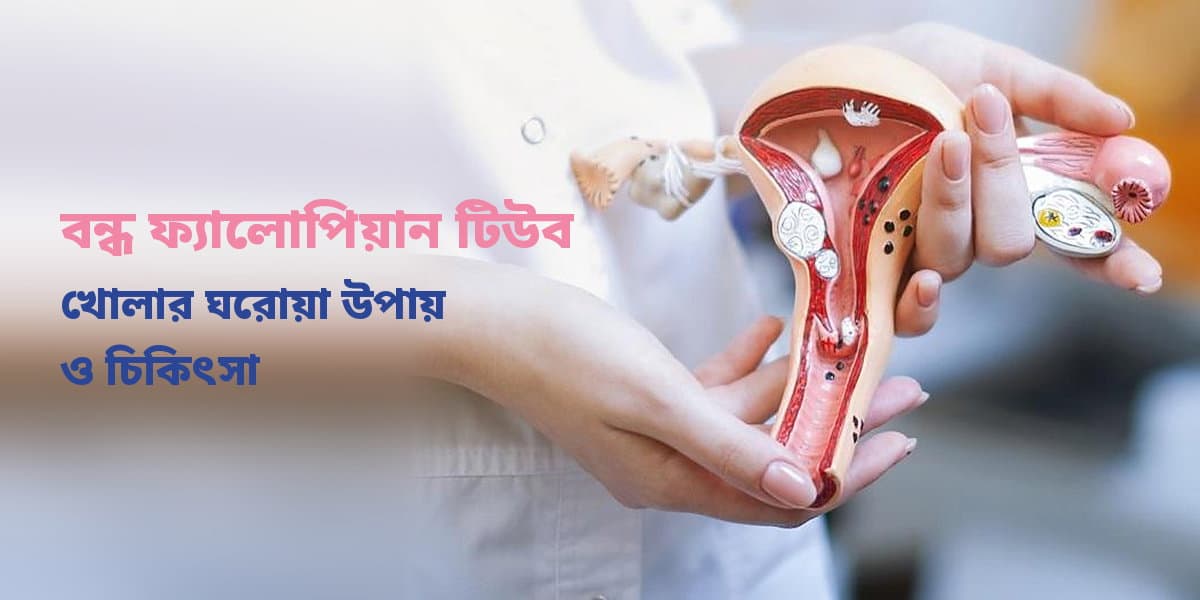 বন্ধ ফ্যালোপিয়ান টিউব খোলার ঘরোয়া উপায় ও চিকিৎসা