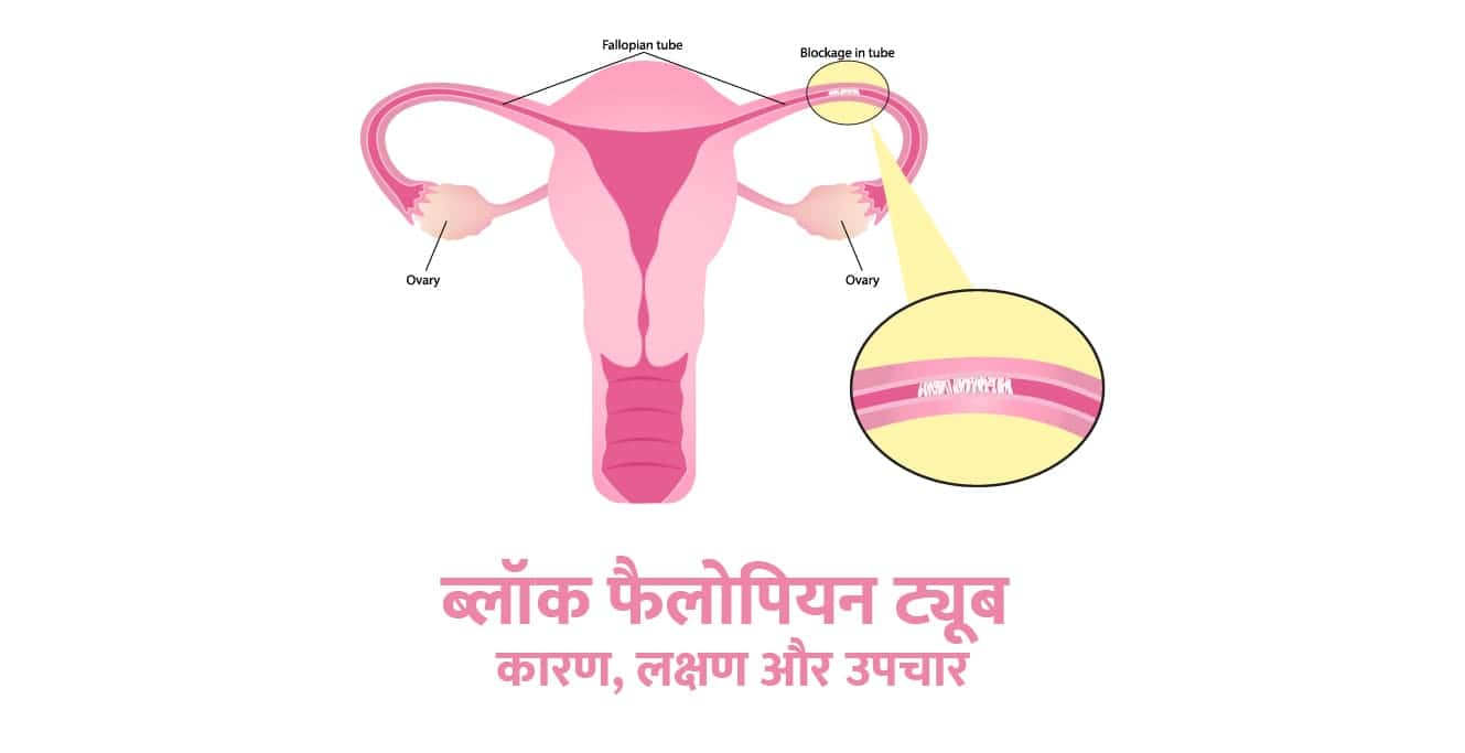 ब्लॉक फेलोपियन ट्यूब - कारण, लक्षण और उपचार (Blocked Fallopian Tube in Hindi)