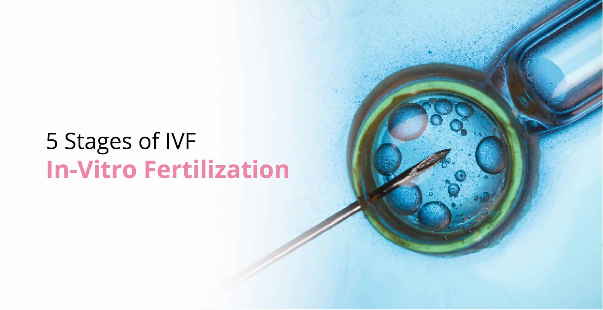 What are the 5 Stages of IVF?