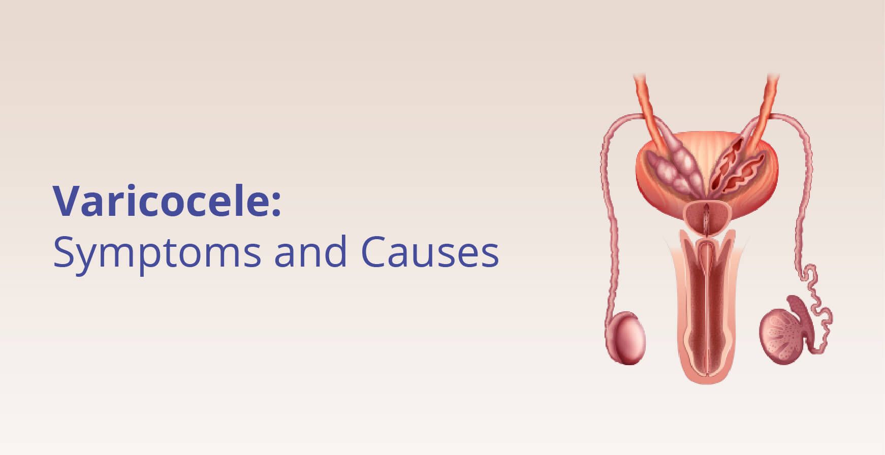 Varicocele – Causes, Symptoms & Treatment