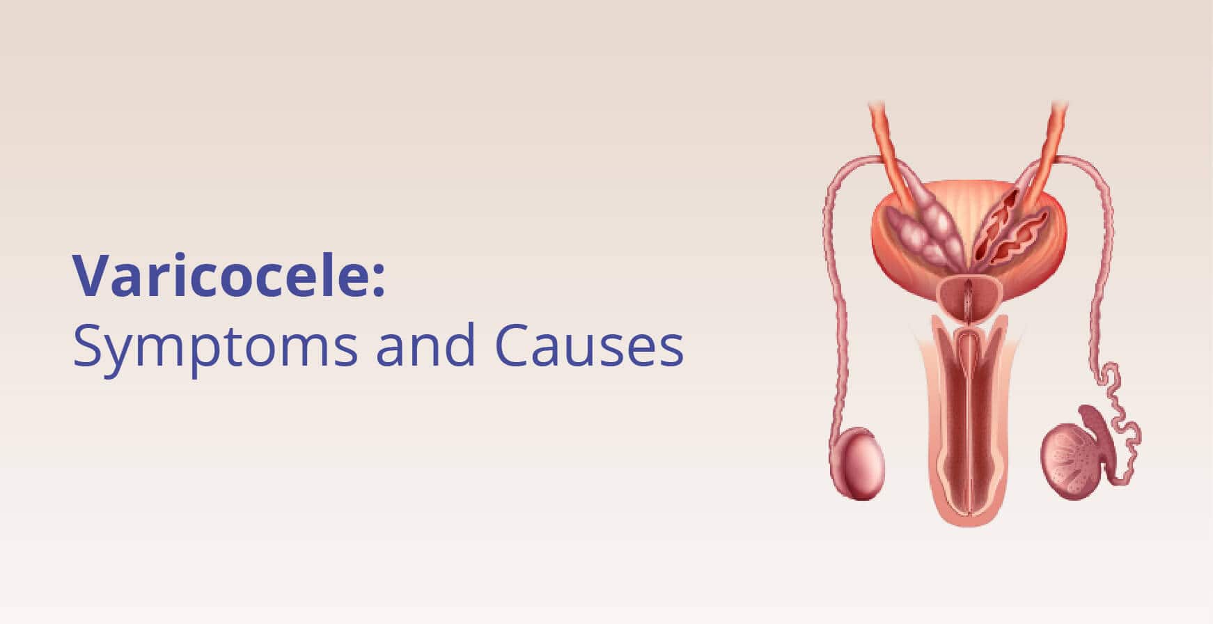 Varicocele - Causes, Symptoms & Treatment