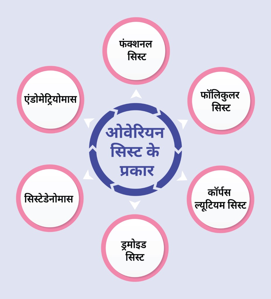 Types-of-ovarian-cyst-in-hindi-in flowchart as infographic