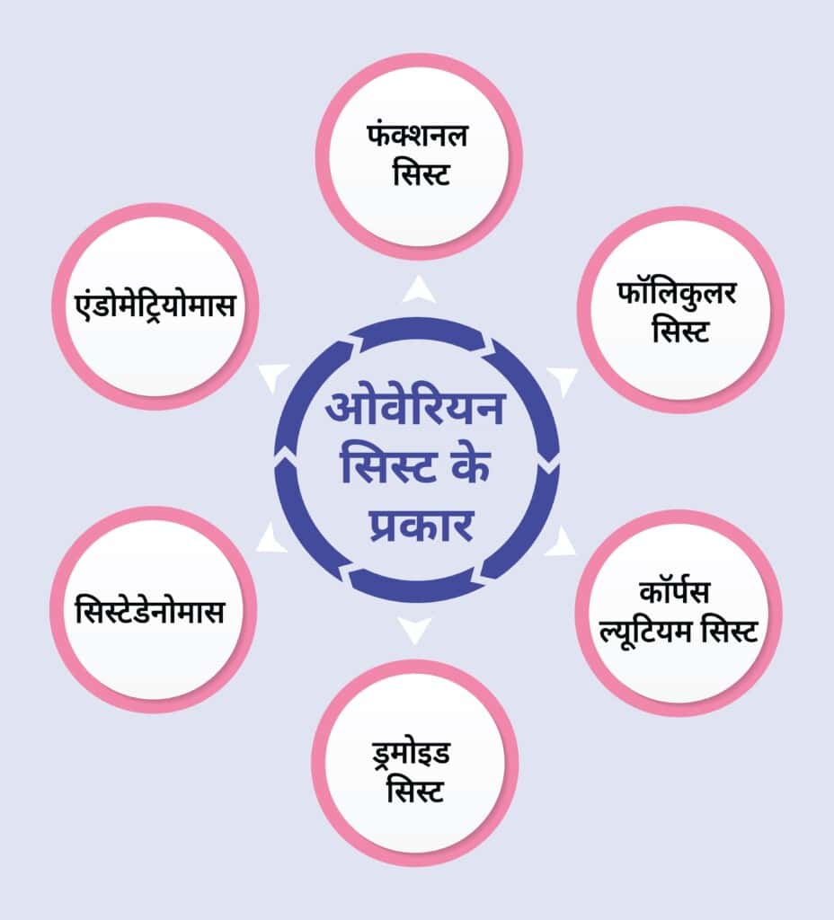 Types-of-ovarian-cyst-in-hindi-in flowchart as infographic