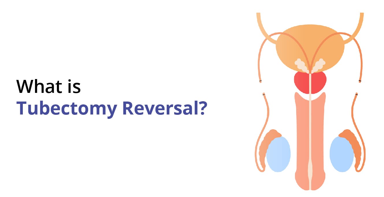 What is Tubectomy Reversal?