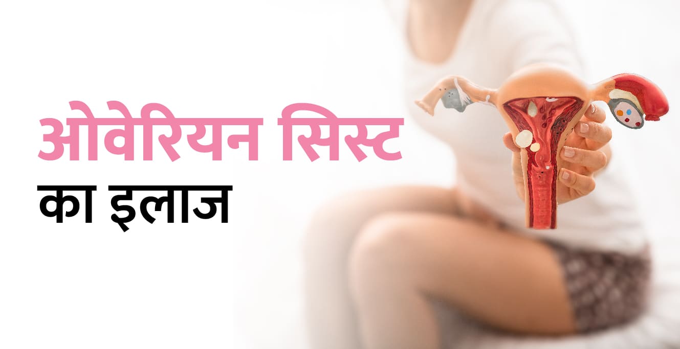 ओवेरियन सिस्ट का इलाज (Ovarian Cyst ka Ilaj in Hindi)