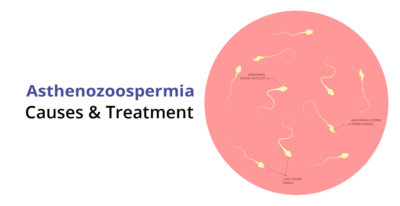 What is Asthenozoospermia