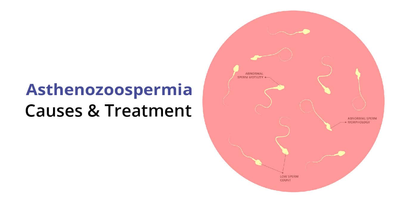 Asthenozoospermia ڇا آهي؟