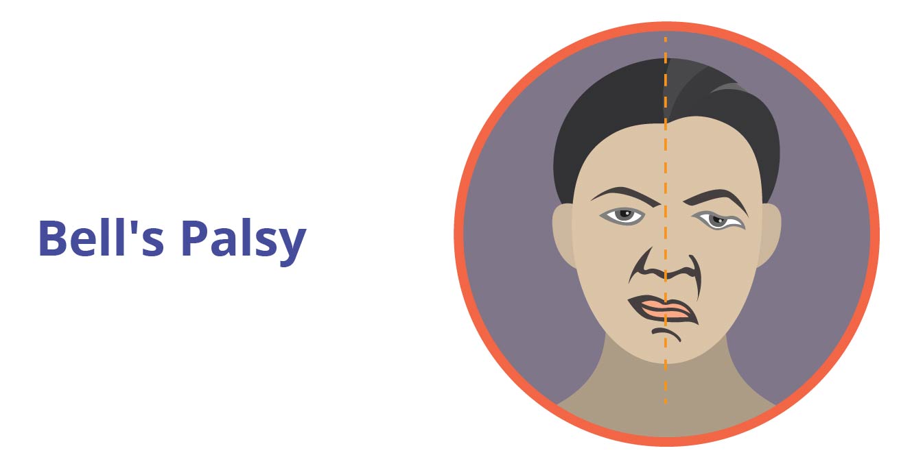 What is Bell’s palsy