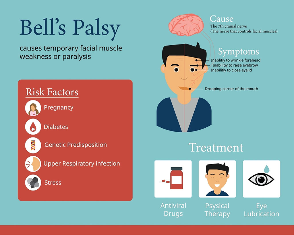 Causes of Bell Palsy