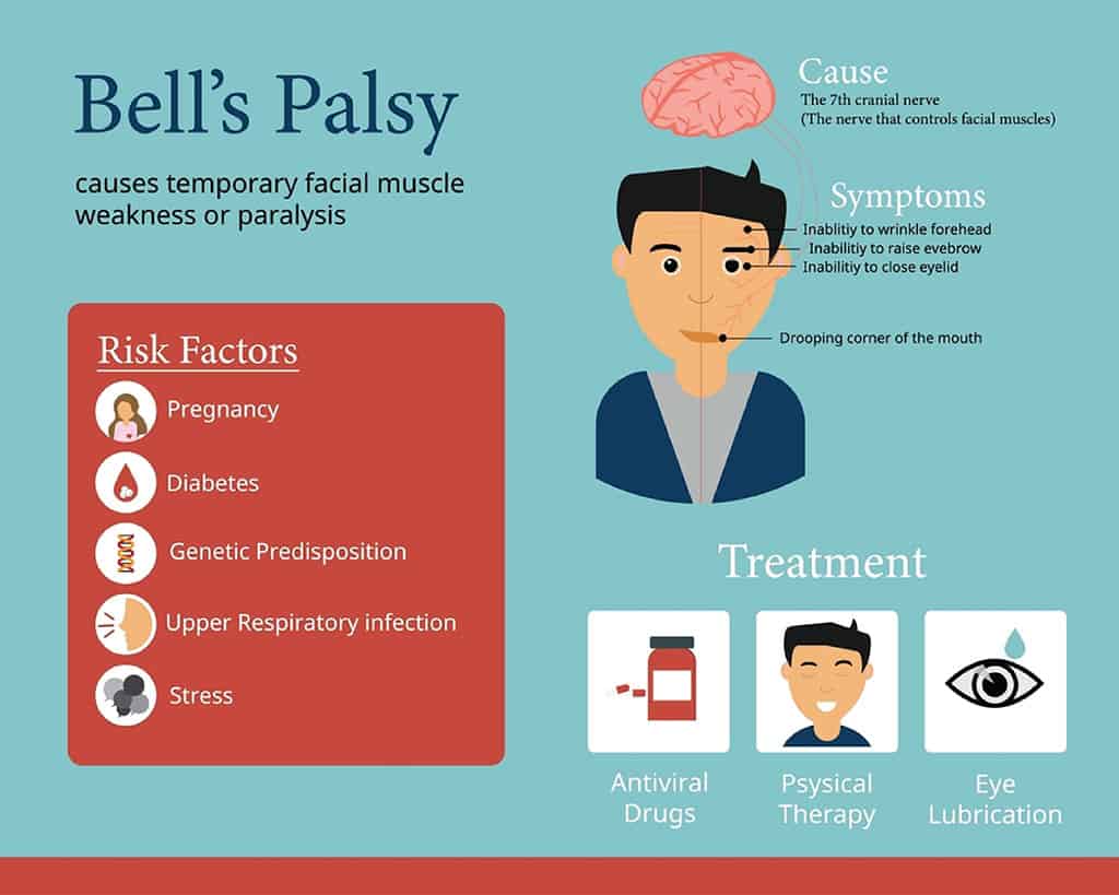 Bell's Palsy, Symptoms, Causes & Treatment Birla Fertility & IVF