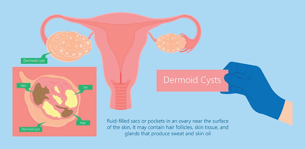 Ovarian dermoid cyst