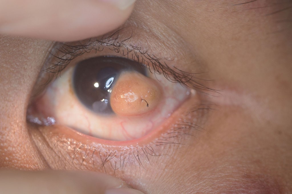 dermoid cyst eye