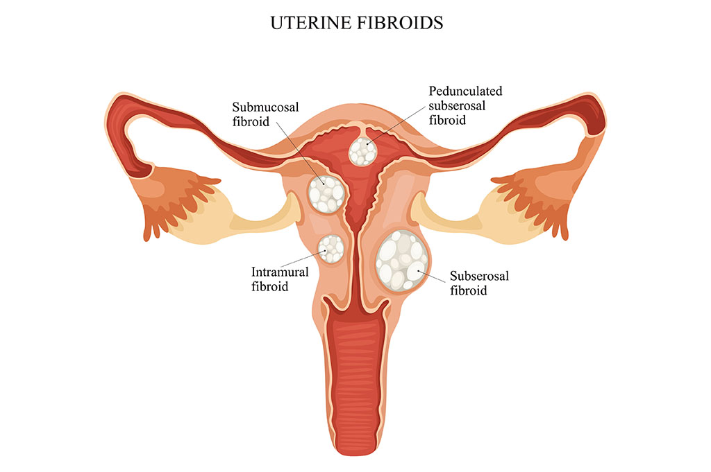 Types of Uterine Fibroids