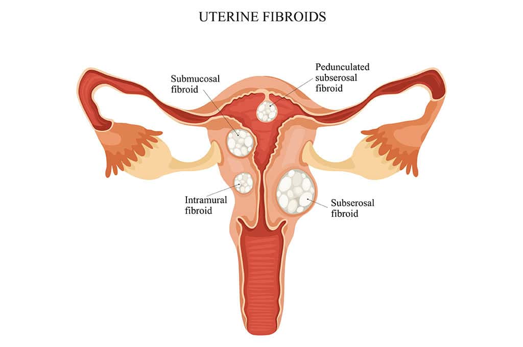 Uterine Fibroids جا قسم