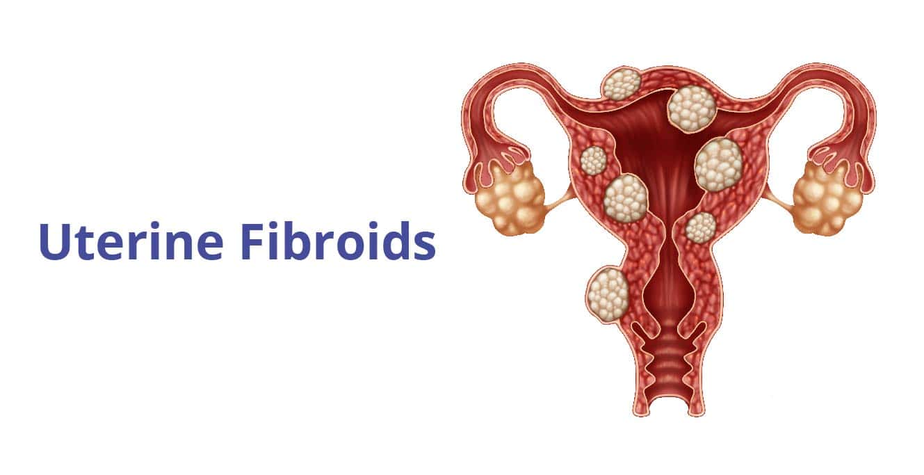 Uterine Fibroids، علامات، سبب ۽ ان جا قسم