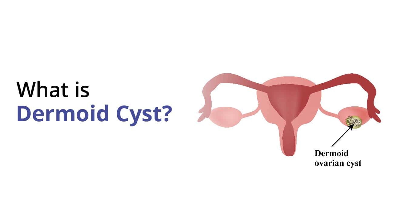 Dermoid Cyst ڇا آهي؟