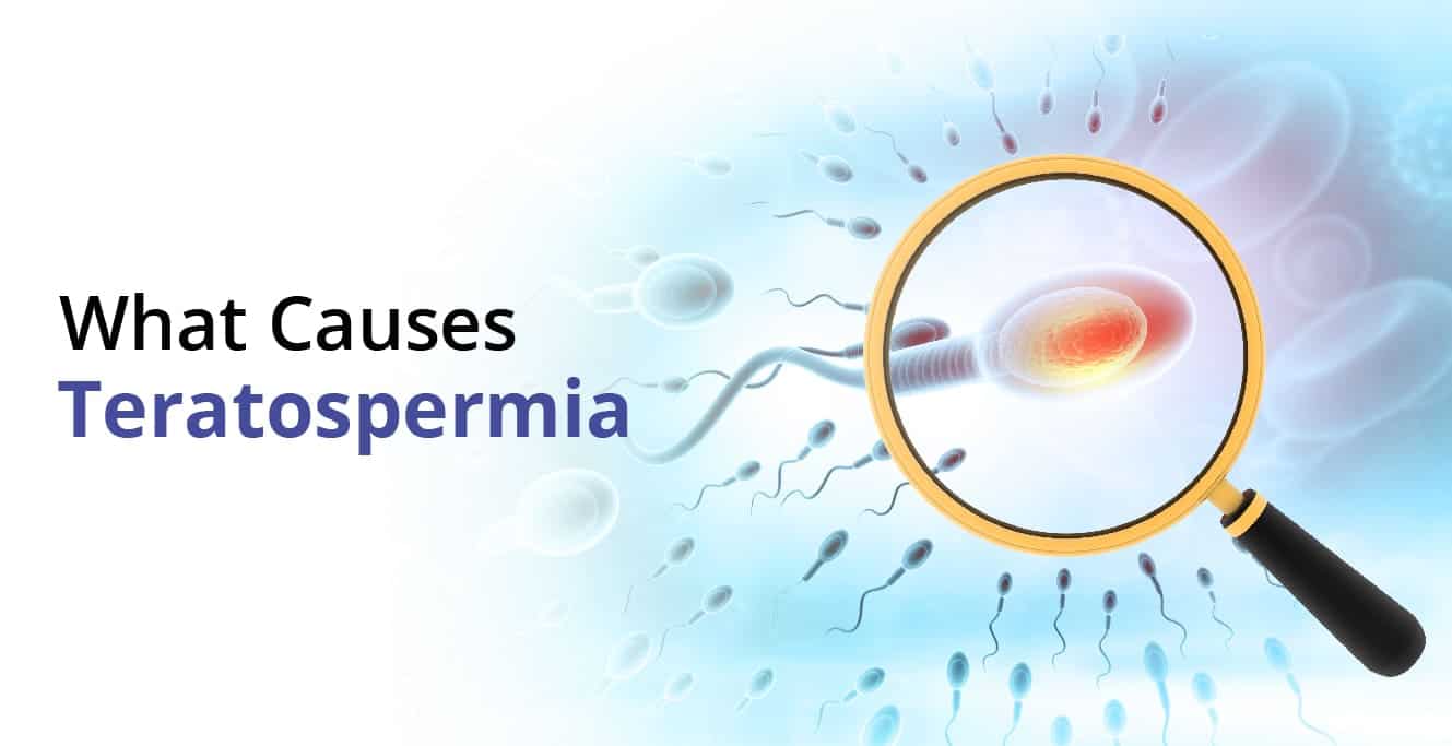 Teratospermia ڇا آهي، سبب، علاج ۽ تشخيص