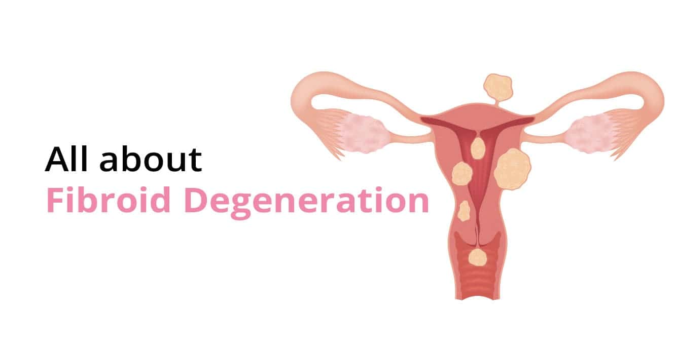 What is Fibroid Degeneration? – Types, Causes & Symptoms