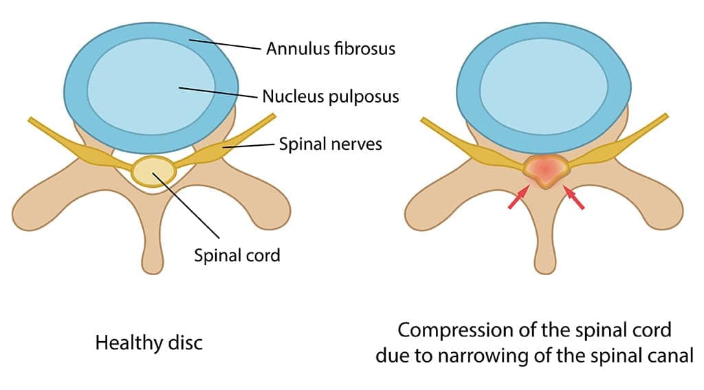 Cervical Stenosis Everything You Should Know Birla Fertility And Ivf 