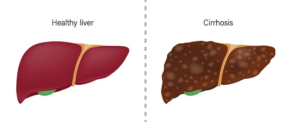 Complications of liver disease