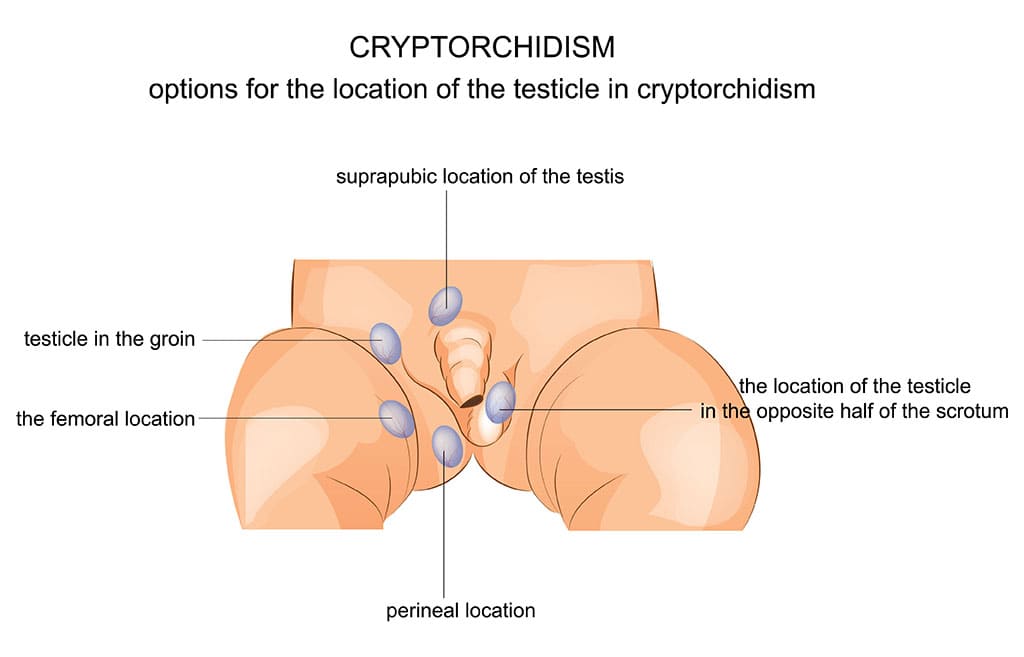 Cryptorchidism complications