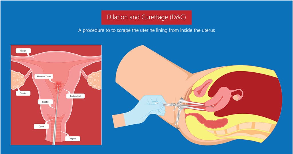 Dilation and Curettage (D & C)