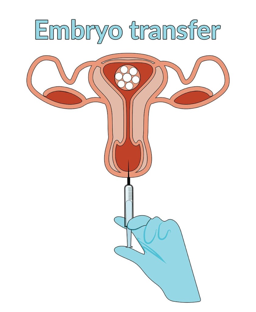 Embryo transfer-01