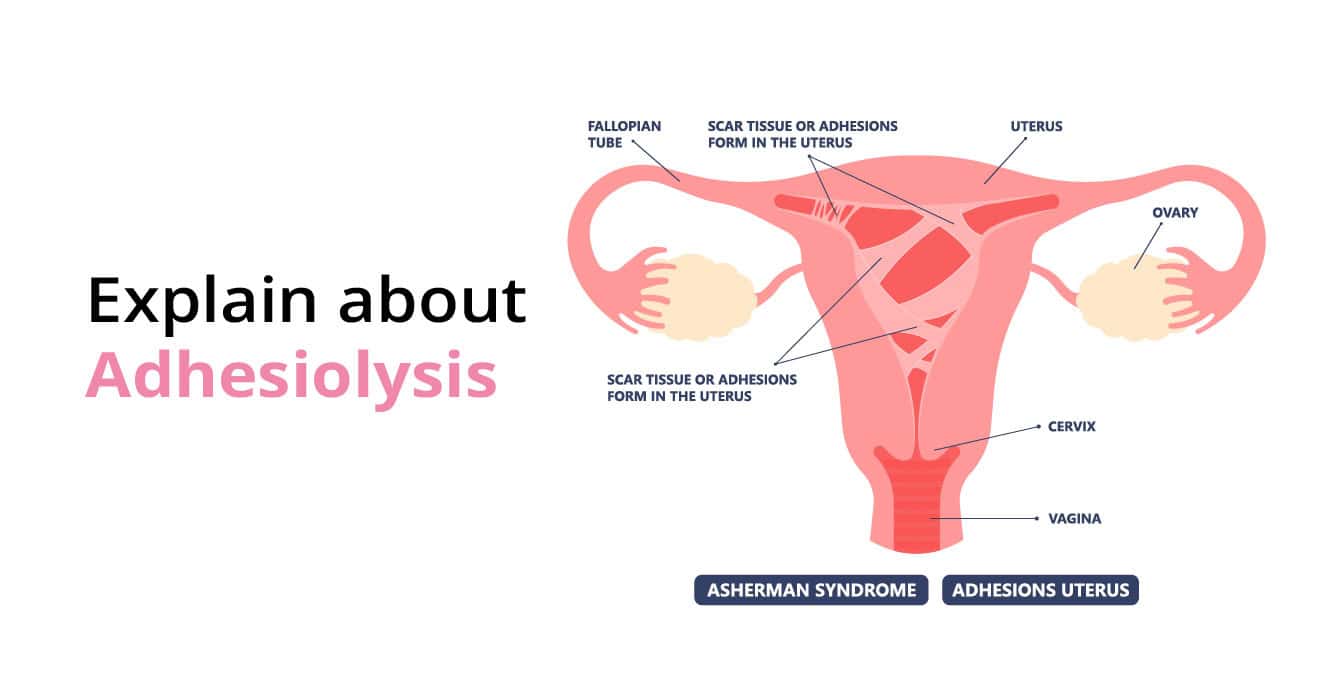 Adhesiolysis لاء مڪمل ھدايت: سبب، تشخيص، ۽ خطرات شامل آھن