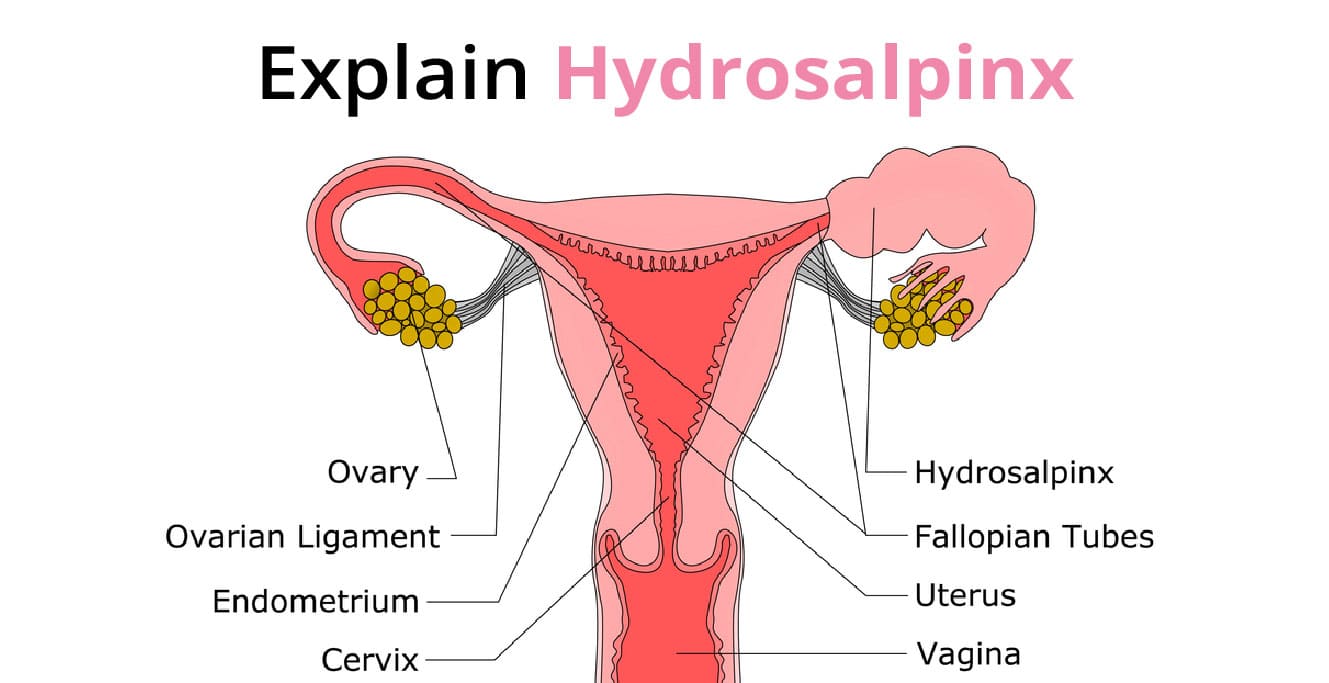 What is Hydrosalpinx