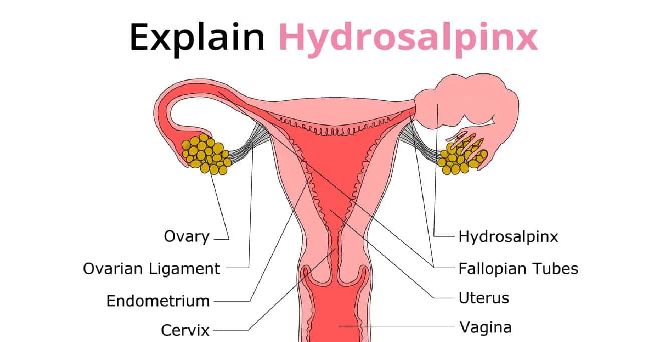 Hydrosalpinx ڇا آهي سبب، علامات ۽ علاج