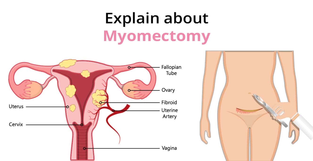 Myomectomy ڇا آهي؟ - قسم، خطرات ۽ پيچيدگيون