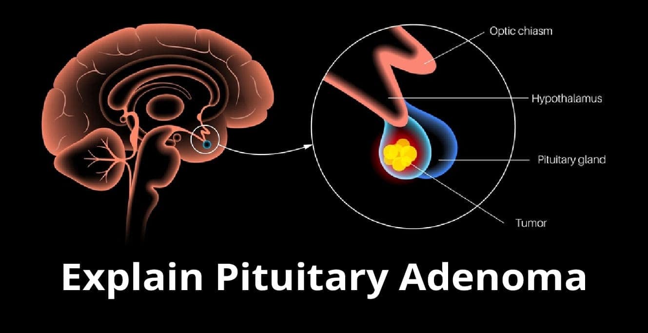 Pituitary Adenoma: قسم، علامات ۽ علاج