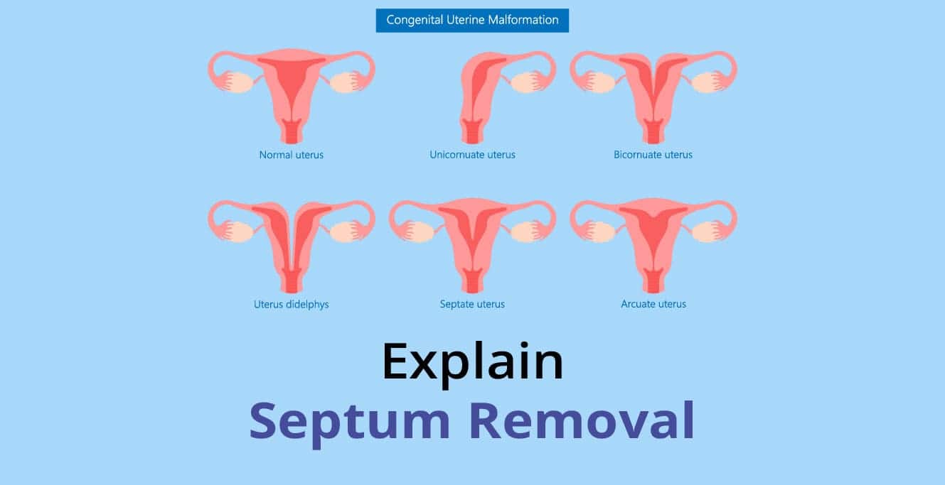 Septum هٽائڻ: توهان جي رحم جي صحت بابت ڄاڻڻ لاء سڀ ڪجهه