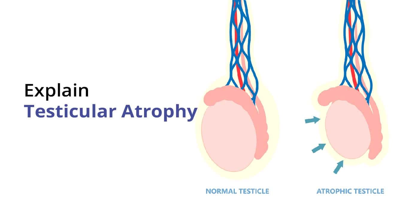 Testicular Atrophy: سڀ ڪجھ توهان کي ڄاڻڻ جي ضرورت آهي