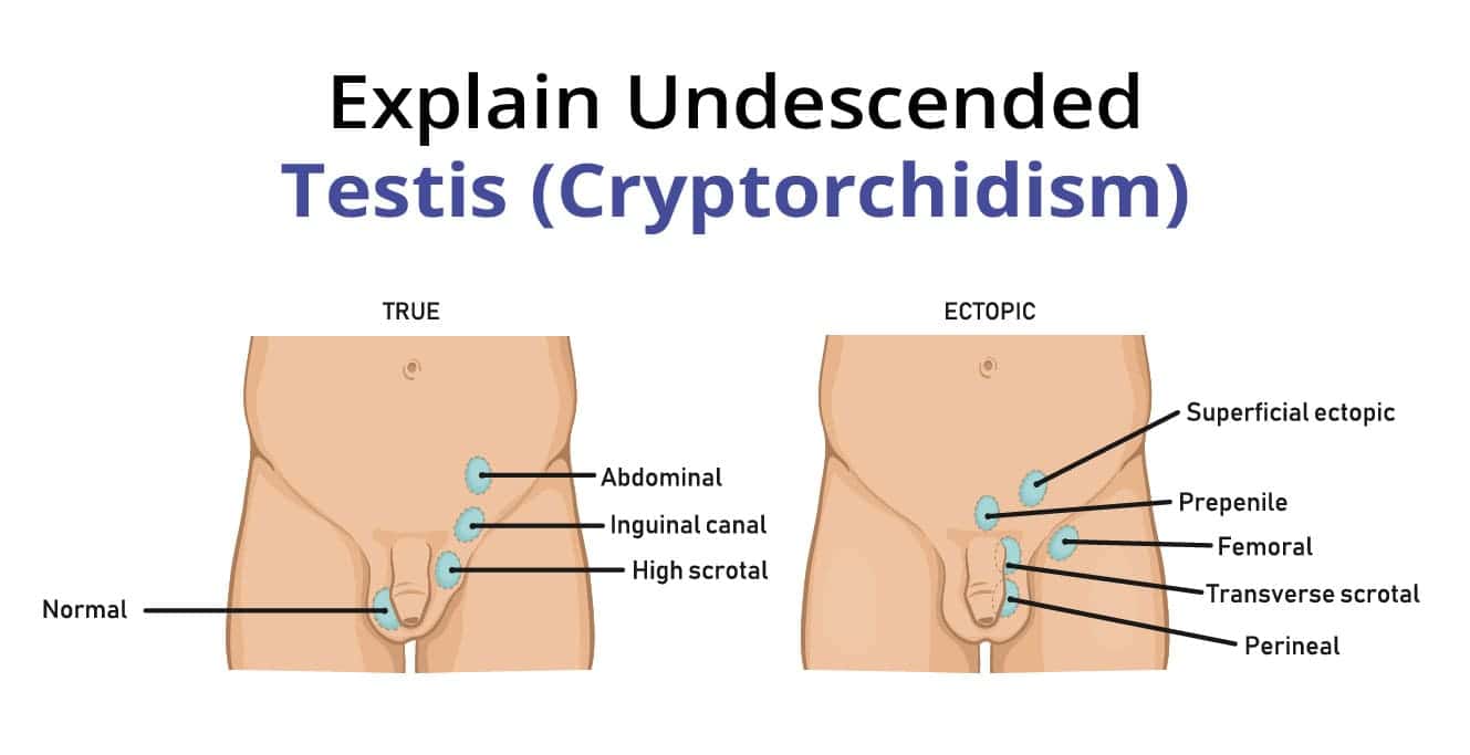 اڻ ڄاتل ٽيسٽس (cryptorchidism)