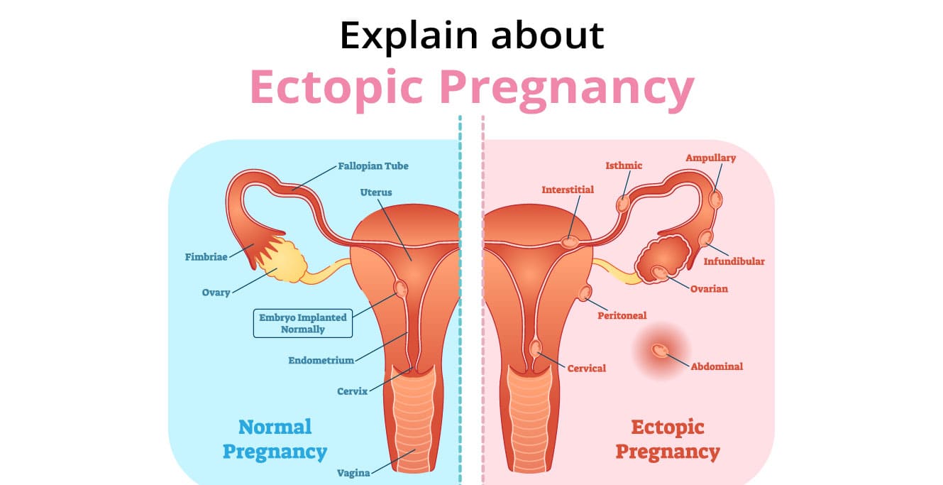 What is an Ectopic Pregnancy?