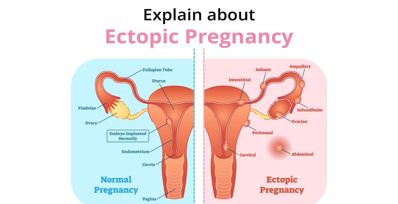 Ectopic حمل ڇا آهي؟