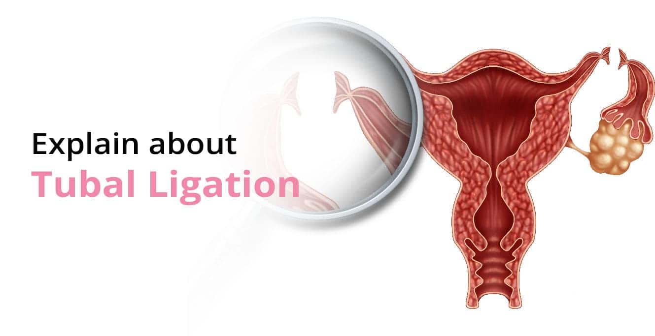 Tubal Ligation: سڀ ڪجهه هڪ عورت کي ڄاڻڻ جي ضرورت آهي