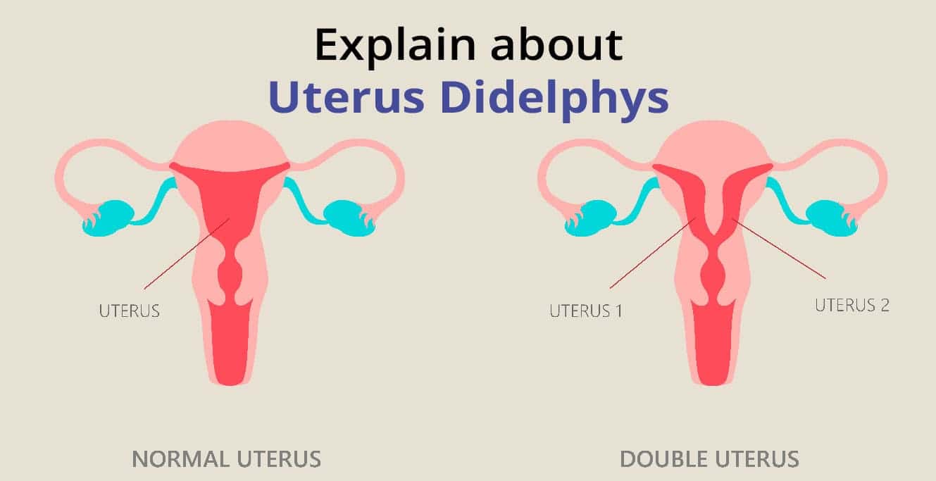 Uterus Didelphys: سبب، علامات، ۽ علاج