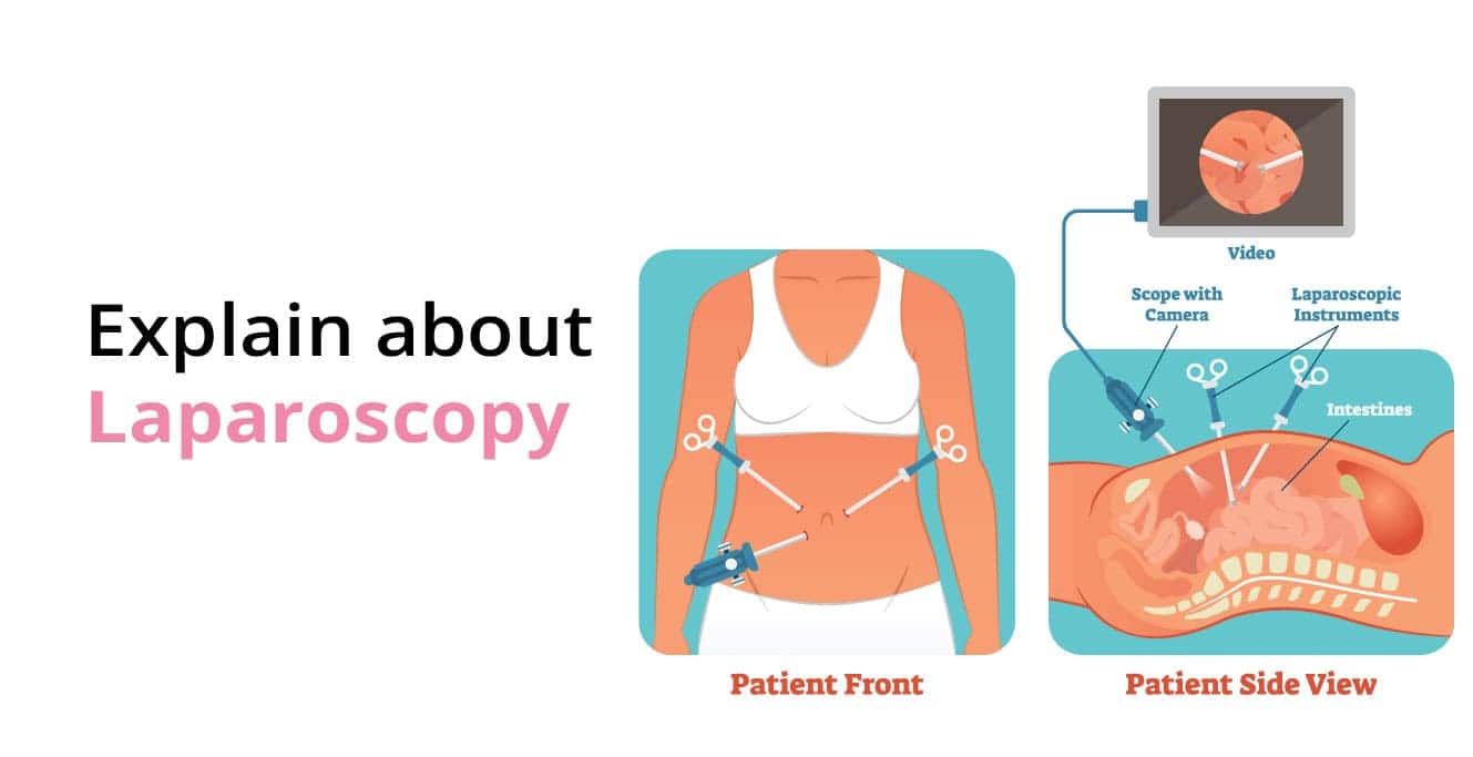 Laparoscopy: توهان سڀني کي ڄاڻڻ جي ضرورت آهي